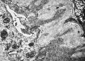 F,74y. | membranous glomerulopathy F,74y. | membranous glomerulopathy